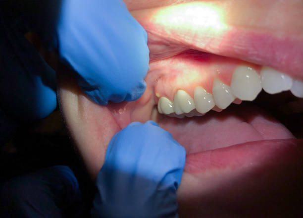 Best Emergency Dental Care for Broken or Chipped Teeth in Canton, OH